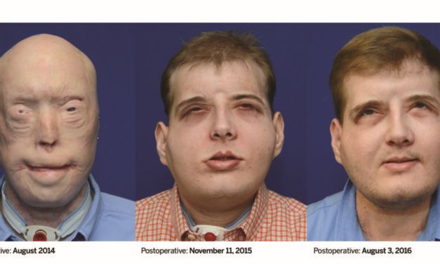 A Year Later, Firefighter with Most Extensive Face Transplant in History is ‘Thriving’