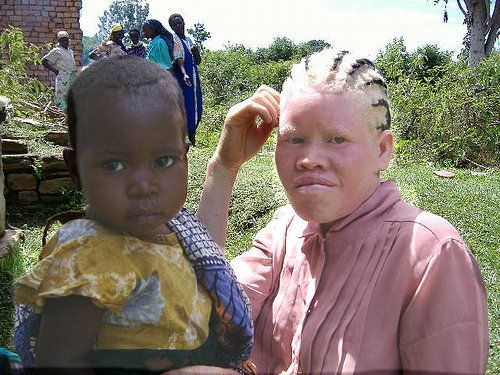 Albino Girl